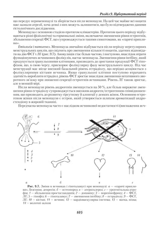 Розділ 9. Пубертатний період

що передує перименопаузі та зберігається після менопаузи. На цей час майже всі ооцити
вже зазнали атрезії, хоча деякі з них можуть залишитися, що було підтверджено даними
гістологічного дослідження.
    Менопауза є основною стадією протягом клімактерію. Протягом цього періоду відбу
ваються різні фізіологічні та гормональні зміни, включаючи зменшення рівня естрогенів,
збільшення секреції ФСГ, що супроводжується такими симптомами, як «гарячі припли
ви».
    Етіологія і патогенез. Менопауза звичайно відбувається після періоду нерегулярних
менструальних циклів, що свідчить про зменшення кількості ооцитів, здатних відповіда
ти на дію ФСГ і ЛГ (рис. 9.7). Ановуляція стає більш частою, і поступово, внаслідок втрати
функціонуючих яєчникових фолікулів, настає менопауза. Зменшення рівня інгібіну, який
продукується гранульозними клітинами, призводить до зростання продукції ФСГ гіпо
фізом, що, в свою чергу, прискорює фолікулярну фазу менструального циклу. Під час
менструації має місце високий базальний рівень естрадіолу, що нерідко асоціюється з
фолікулярними кістами яєчника. Якщо гранульозні клітини поступово втрачають
здатність виробляти естрадіол, рівень ФСГ зростає внаслідок зменшення негативного зво
ротного зв’язку при зниженні секреції естрогенів яєчниками. Рівень ЛГ також зростає,
але в меншій мірі.
    Після менопаузи рівень андрогенів зменшується на 50 %, але більш виражене змен
шення рівня естрадіолу супроводжується високим андроген/естрогенним співвідношен
ням, що призводить до розвитку гірсутизму й алопеції у деяких жінок. Основним естро
геном жінки після менопаузи є естрон, який утворюється шляхом ароматизації андро
стендіону в жировій тканині.
    Передчасна менопауза часто є наслідком яєчникової недостатності (виснаження яєч


                6                                                     11

                              7
                              8

                              9

                 5

            4
            3                           10                    12                  13       14
            2
            1




        а                        б                           в                       г
         Рис. 9.7. Зміни в яєчниках і гіпоталамусі при менопаузі: а — «гарячі припли
      ви», безсоння, депресія; б — остеопороз; в — атеросклероз; г — урогенітальна атро
      фія; 1 — збільшення простагландинів; 2 — допаміну; 3 — норепінефрину; 4 — ФСГ,
      ЛГ; 5 — гіпофіз; 6 — гіпоталамус; 7 — зменшення інгібіну; 8 — естрадіолу; 9 — ФСГ,
      ЛГ; 10 — кістки; 11 — яєчник; 12 — кардіоваскулярна система; 13 — матка, піхва;
      14 — молочні залози


                                             105
 