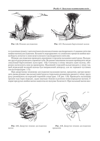 Розділ 1. Загальна симптоматологія...




   Рис. 1.6. Піхвове дослідження                 Рис. 1.7. Пальпація бартолінової залози


го склепіння піхви), і цитологічного (плоскоклітинно циліндричного з’єднання епітелію
шийки матки) дослідження. Більшість передракових та злоякісних процесів шийки мат
ки беруть початок із зони межі плоского і циліндричного епітелію.
    Піхвове дослідження проводять вказівним і середнім пальцями однієї руки. Пальця
ми другої руки розводять соромітні губи. Великим і вказівним пальцем промацують місце
локалізації бартолінових залоз (рис. 1.6). Спочатку в піхву вводять один палець, обе
режно натискують ним на промежину. Вказівний і середній пальці вводять у піхву так,
щоб відведений великий палець був направлений допереду, але не торкався чутливих
зон (клітора) (рис. 1.7).
    При дворучному піхвовому дослідженні пальпацію матки, придатків, уретри прово
дять двома руками: два пальці однієї руки в стерильних рукавичках вводять у піхву; другу
руку розміщують на передній черевній стінці (рис. 1.8, рис. 1.9). Проводять пальпацію
органів таза через переднє, заднє (матка) і бокові склепіння піхви (придатки матки). У
нормі при рухах шийки матки пацієнтка не відчуває болючості. При пальпації матки виз




   Рис. 1.8. Дворучне піхвове дослідження          Рис. 1.9. Дворучне піхвове дослідження
матки                                           придатків

                                            9
 