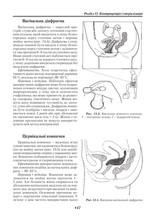 Розділ 13. Контрацепція і стерилізація

      Вагінальна діафрагма
    Вагінальна діафрагма — округлий при
стрій з гуми або латексу, оточений еластич
ним кільцем, який вводиться в піхву безпо
середньо перед статевим актом і вкриває
шийку матки (рис. 13.4). Діафрагма і спер
міциди повинні бути введені в піхву безпо
середньо перед статевим актом і залишити
ся там протягом 6–8 год після статевого акту.
Якщо інший статевий акт відбувається про
тягом 6–8 год після першого статевого акту,
у піхву додатково вводяться сперміциди без
видалення діафрагми.
    Ефективність. Хоча теоретична ефек
тивність цього методу контрацепції дорівнює
94 %, реальна не перевищує 80–85 %.
    Переваги і недоліки. Побічним ефектом
використання діафрагми може бути подраз
нення сечового міхура, цистит, колонізація
мікроорганізмів, у тому числі золотистого
стафілокока, що може призвести до розвит         1
ку синдрому токсичного шоку. Жінки мо
жуть мати підвищену чутливість до латек
су, гуми або сперміцидів. Діафрагма повин
                                                                 2
на бути підібрана і введена лікарем і замі
нюється кожні 5 років або при збільшенні           Рис. 13.3. Введення жіночого кондома:
чи зменшенні маси тіла > 5 кг. Жінки з та       1 — внутрішнє кільце; 2 — відкритий кінець
зовими пролапсами не можуть використо
вувати цей метод контрацепції.


      Цервікальні ковпачки
   Цервікальні ковпачки — маленькі, м’які
гумові чашечки, які надягаються безпосеред
ньо на шийку матки (рис. 13.5) для запобі
гання потраплянню сперми у порожнину мат
ки. Ковпачки підбираються лікарем і засто
совуються разом зі сперміцидним гелем.
   Ефективність використання цервікаль
них ковпачків подібна до вагінальних діаф
рагм — 80–85 %.
   Переваги і недоліки. Ковпачок може за
лишатися на шийці матки протягом 1–
2 днів. Але більшість жінок скаржаться на
збільшення вагінальних виділень після пер
шого дня, незручності при введенні та виве
денні ковпачків. Основною причиною не
вдач є порушення локалізації ковпачків. У
зв’язку з цим частота використання цього             Рис. 13.4. Введення вагінальної діафрагми

                                          147
 