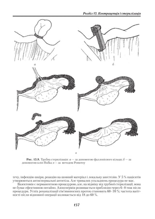 Розділ 13. Контрацепція і стерилізація




              а                                                        б




                                            в

         Рис. 13.8. Трубна стерилізація: а — за допомогою фаллопієвого кільця; б — за
      допомогою кліп Hulka; в — за методом Pomeroy



течу, інфекцію шкіри, реакцію на шовний матеріал і локальну анестезію. У 5 % пацієнтів
утворюються антиспермальні антитіла. Але тривалих ускладнень процедура не має.
   Вазектомія є перманентною процедурою, але, на відміну від трубної стерилізації, вона
не буває ефективною негайно. Азооспермія розвивається приблизно через 6–8 тиж після
процедури. Успіх реканалізації сім’явиносних проток становить 60–70 %; частота вагіт
ності після відновної операції коливається від 18 до 60 %.


                                           157
 