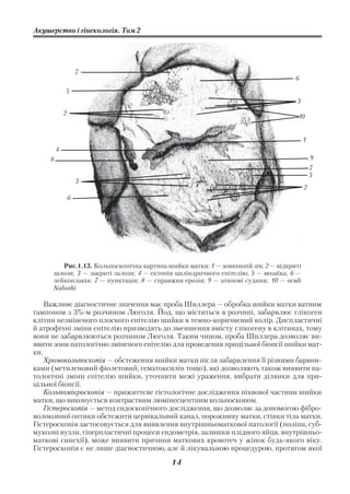 Акушерство і гінекологія. Том 2




                     7
                                                                                   6
             5
                                                                                   3
             2                                                                      10


                                                                                        1
         4
     8                                                                                      9
                                                                                            7
                                                                                            5
                     3
                                                                                        2
                 6




        Рис.1.13. Кольпоскопічна картина шийки матки: 1 — зовнішній зів; 2 — відкриті
     залози; 3 — закриті залози; 4 — ектопія циліндричного епітелію; 5 — мозаїка; 6 —
     лейкоплакія; 7 — пунктація; 8 — справжня ерозія; 9 — атипові судини; 10 — ovuli
     Nabothi

    Важливе діагностичне значення має проба Шиллера — обробка шийки матки ватним
тампоном з 3% м розчином Люголя. Йод, що міститься в розчині, забарвлює глікоген
клітин незміненого плоского епітелію шийки в темно коричневий колір. Диспластичні
й атрофічні зміни епітелію призводять до зменшення вмісту глікогену в клітинах, тому
вони не забарвлюються розчином Люголя. Таким чином, проба Шиллера дозволяє ви
явити зони патологічно зміненого епітелію для проведення прицільної біопсії шийки мат
ки.
    Хромокольпоскопія — обстеження шийки матки після забарвлення її різними барвни
ками (метиленовий фіолетовий, гематоксилін тощо), які дозволяють також виявити па
тологічні зміни епітелію шийки, уточнити межі ураження, вибрати ділянки для при
цільної біопсії.
    Кольпомікроскопія — прижиттєве гістологічне дослідження піхвової частини шийки
матки, що виконується контрастним люмінесцентним кольпоскопом.
    Гістероскопія — метод ендоскопічного дослідження, що дозволяє за допомогою фібро
волоконної оптики обстежити цервікальний канал, порожнину матки, стінки тіла матки.
Гістероскопія застосовується для виявлення внутрішньоматкової патології (поліпи, суб
мукозні вузли, гіперпластичні процеси ендометрія, залишки плідного яйця, внутрішньо
маткові синехії), може виявити причини маткових кровотеч у жінок будь якого віку.
Гістероскопія є не лише діагностичною, але й лікувальною процедурою, протягом якої
                                           14
 