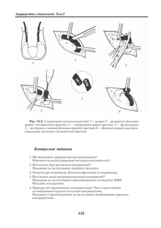 Акушерство і гінекологія. Том 2




                                        2
          1
                                                                           3




                                             5



                 4                                                     6


        Рис. 13.9. Стерилізація шляхом вазектомії: 1 — розріз; 2 — розкриття оболонки
     правої сім’явиносної протоки; 3 — перерізання правої протоки; 4 — фульгурація;
     5 — деструкція слизової оболонки просвіту протоки; 6 — оболонка закрита над прок
     симальною частиною сім’явиносної протоки




              Контрольні питання

        1. Що включають природні методи контрацепції?
           Переваги і недоліки природних методів планування сім’ї.
        2. Які існують бар’єрні методи контрацепції?
           Показання до застосування, переваги і недоліки.
        3. Поняття про сперміциди. Клінічна ефективність сперміцидів.
        4. Які існують види внутрішньоматкової контрацепції?
           Показання до застосування гормонвміщуючих та інертних ВМК.
           Можливі ускладнення.
        5. Принцип дії гормональних контрацептивів. Чисто прогестинові
           та комбіновані естроген гестагенні контрацептиви.
           Показання і протипоказання до застосування комбінованих оральних
           контрацептивів.




                                            158
 