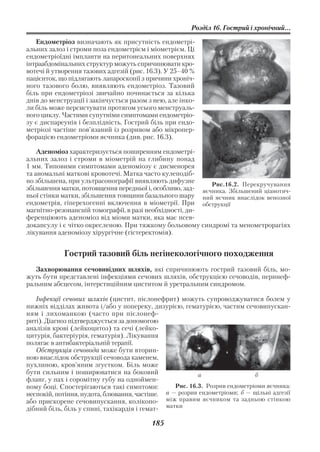 Розділ 16. Гострий і хронічний...

   Ендометріоз визначають як присутність ендометрі
альних залоз і строми поза ендометрієм і міометрієм. Ці
ендометріоїдні імпланти на перитонеальних поверхнях
інтраабдомінальних структур можуть спричинювати кро
вотечі й утворення тазових адгезій (рис. 16.3). У 25–40 %
пацієнток, що підлягають лапароскопії з причини хроніч
ного тазового болю, виявляють ендометріоз. Тазовий
біль при ендометріозі звичайно починається за кілька
днів до менструації і закінчується разом з нею, але інко
ли біль може персистувати протягом усього менструаль
ного циклу. Частими супутніми симптомами ендометріо
зу є диспареунія і безплідність. Гострий біль при ендо
метріозі частіше пов’язаний із розривом або мікропер
форацією ендометріоми яєчника (див. рис. 16.3).

    Аденоміоз характеризується поширенням ендометрі
альних залоз і строми в міометрій на глибину понад
1 мм. Типовими симптомами аденоміозу є дисменорея
та аномальні маткові кровотечі. Матка часто кулеподіб
но збільшена, при ультрасонографії виявляють дифузне        Рис.16.2. Перекручування
збільшення матки, потовщення передньої і, особливо, зад  яєчника. Збільшений ціанотич
ньої стінки матки, збільшення товщини базального шару ний яєчник внаслідок венозної
ендометрія, гіперехогенні включення в міометрії. При обструкції
магнітно резонансній томографії, в разі необхідності, ди
ференціюють аденоміоз від міоми матки, яка має псев
докапсулу і є чітко окресленою. При тяжкому больовому синдромі та менометрорагіях
лікування аденоміозу хірургічне (гістеректомія).


            Гострий тазовий біль негінекологічного походження
   Захворювання сечовивідних шляхів, які спричинюють гострий тазовий біль, мо
жуть бути представлені інфекціями сечових шляхів, обструкцією сечоводів, перинеф
ральним абсцесом, інтерстиційним циститом й уретральним синдромом.

   Інфекції сечових шляхів (цистит, пієлонефрит) можуть супроводжуватися болем у
нижніх відділах живота і/або у попереку, дизурією, гематурією, частим сечовипускан
ням і лихоманкою (часто при пієлонеф
риті). Діагноз підтверджується за допомогою
аналізів крові (лейкоцитоз) та сечі (лейко
цитурія, бактеріурія, гематурія). Лікування
полягає в антибактеріальній терапії.
   Обструкція сечовода може бути вторин
ною внаслідок обструкції сечовода каменем,
пухлиною, кров’яним згустком. Біль може
бути сильним і поширюватися на боковий                   а                  б
фланг, у пах і соромітну губу на одноймен
ному боці. Спостерігаються такі симптоми:        Рис. 16.3. Розрив ендометріоми яєчника:
неспокій, потіння, нудота, блювання, частіше. а — розрив ендометріоми; б — щільні адгезії
або прискорене сечовипускання, колікопо       між правим яєчником та задньою стінкою
                                              матки
дібний біль, біль у спині, тахікардія і гемат

                                          185
 