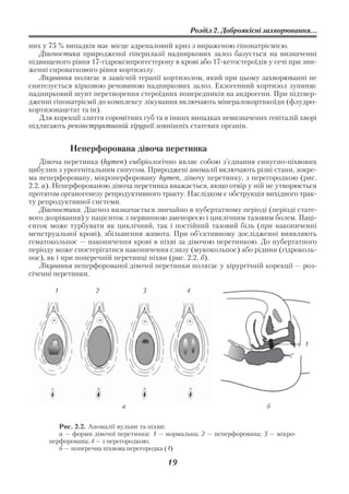 Розділ 2. Доброякісні захворювання...

них у 75 % випадків має місце адреналовий криз з вираженою гіпонатріємією.
   Діагностика природженої гіперплазії надниркових залоз базується на визначенні
підвищеного рівня 17 гідроксипрогестерону в крові або 17 кетостероїдів у сечі при зни
женні сироваткового рівня кортизолу.
   Лікування полягає в замісній терапії кортизолом, який при цьому захворюванні не
синтезується кірковою речовиною надниркових залоз. Екзогенний кортизол зупиняє
наднирковий шунт перетворення стероїдних попередників на андрогени. При підтвер
дженні гіпонатріємії до комплексу лікування включають мінералокортикоїди (флудро
кортизонацетат та ін).
   Для корекції злиття соромітних губ та в інших випадках невизначених геніталій хворі
підлягають реконструктивній хірургії зовнішніх статевих органів.


            Неперфорована дівоча перетинка
    Дівоча перетинка (hymen) ембріологічно являє собою з’єднання синусно піхвових
цибулин з урогенітальним синусом. Природжені аномалії включають різні стани, зокре
ма неперфоровану, мікроперфоровану hymen, дівочу перетинку, з перегородкою (рис.
2.2, а). Неперфорованою дівоча перетинка вважається, якщо отвір у ній не утворюється
протягом органогенезу репродуктивного тракту. Наслідком є обструкція вихідного трак
ту репродуктивної системи.
    Діагностика. Діагноз визначається звичайно в пубертатному періоді (періоді стате
вого дозрівання) у пацієнток з первинною аменореєю і циклічним тазовим болем. Паці
єнток може турбувати як циклічний, так і постійний тазовий біль (при накопиченні
менструальної крові), збільшення живота. При об’єктивному дослідженні виявляють
гематокольпос — накопичення крові в піхві за дівочою перетинкою. До пубертатного
періоду може спостерігатися накопичення слизу (мукокольпос) або рідини (гідроколь
пос), як і при поперечній перетинці піхви (рис. 2.2, б).
    Лікування неперфорованої дівочої перетинки полягає у хірургічній корекції — роз
січенні перетинки.

       1            2             3             4




                                                                                    1




                            а                                           б


         Рис. 2.2. Аномалії вульви та піхви:
         а — форми дівочої перетинки: 1 — нормальна; 2 — неперфорована; 3 — мікро
      перфорована; 4 — з перегородкою;
         б — поперечна піхвова перегородка (1)

                                          19
 