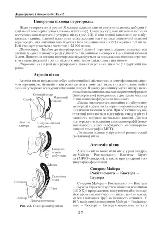 Акушерство і гінекологія. Том 2

             Поперечна піхвова перегородка
   Піхва утворюється з проток Мюллера шляхом злиття синусно піхвових цибулин у
суцільний мюллерів горбок (піхвову пластинку). Спочатку суцільна піхвова пластинка
поступово каналізується й утворює піхву (рис. 2.3). Якщо повної каналізації не відбу
вається, тканина піхвової пластинки може залишитися у вигляді поперечної піхвової
перегородки, яка звичайно локалізується біля з’єднання нижніх 2/3 і верхньої 1/3 піхви.
Цей стан зустрічається з частотою 1:75 000 жінок.
   Діагностика. Подібно до неперфорованої дівочої перетинки, діагноз визначається
частіше в пубертатному періоді у дівчаток з первинною аменореєю і циклічним тазовим
болем. Поперечна піхвова перегородка візуалізується за нормальною дівочою перетин
кою в проксимальній третині піхви і є товстішою і щільнішою, ніж hymen.
   Лікування, як і в разі неперфорованої дівочої перетинки, полягає у хірургічній ко
рекції.

             Атрезія піхви
   Атрезія піхви нерідко потребує диференційної діагностики з неперфорованою діво
чою перетинкою. Агенезія піхви розвивається у тому разі, якщо синусно піхвові цибу
лини не утворюються з урогенітального синуса. В цьому разі шийку матки оточує неве
                                    лика піхвова кишеня, яка має парамезонефральне
            Сечовий міхур           (мюллерівське) походження, а дистальна частина
                          Матковий
     Симфіз                         піхви заміщена фіброзною тканиною.
                          канал
                                       Діагноз визначається звичайно в пубертатно
                                    му періоді у дівчаток із первинною аменореєю та
                                    циклічним тазовим болем. При об’єктивному об
                                    стеженні виявляється відсутність входу в піхву і
                                    наявність широкої вагінальної кишені. Діагноз
  Зачаток      Синусно піхвові      підтверджується даними ультрасонографії (гема
  клітора      цибулини             токольпос) і, у разі необхідності, магнітно резо
                                    нансної томографії (МРТ).
                                       Лікування полягає у хірургічній реконструкції
                                    (витяганні) піхви.

                                                 Агенезія піхви
                          Синусно
                          піхвові        Агенезія піхви може мати місце у разі синдро
                          цибулини    му Майєра — Рокітанського — Кюстера — Гаузе
                                      ра (МРКГ синдром), а також при синдромі тес
                                      тикулярної фемінізації.
                       Матка
                                                 Синдром Майєра —
                                                 Рокітанського — Кюстера —
                          Склепіння              Гаузера
                          піхви
Сечівник                                 Синдром Майєра — Рокітанського — Кюстера
                        Піхва         — Гаузера характеризується жіночим генотипом
                                      (46, ХХ) і природженою відсутністю або гіпопла
                                      зією проксимальної частини піхви, шийки матки,
 Клітор                               матки і маткових труб за наявності яєчників. У
           Дівоча перетинка           10 % пацієнток із синдромом Майєра — Рокітансь
   Рис. 2.3. Стадії розвитку піхви    кого — Кюстера — Гаузера є нормальна матка з

                                         20
 