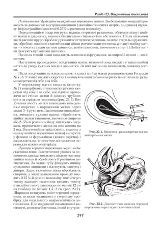 Розділ 23. Оперативна гінекологія

    Поліпектомія і фракційне вишкрібання порожнини матки. Знеболювання операції про
водять за допомогою внутрішньовенного (звичайно тіопентал натрію, диприван) нарко
зу, інфільтраційної анестезії 0,25% м розчином новокаїну.
    Перед операцією лікар миє руки, надягає стерильні рукавички, обстежує піхву і ший
ку матки в дзеркалах, виконує бімануальне гінекологічне обстеження. Після піхвового
дослідження хірург обробляє руки антисептичним розчином, надягає стерильні рукавич
ки, обробляє зовнішні статеві органи жінки розчином антисептика, а піхву і шийку мат
ки — спочатку сухим ватним тампоном, потім тампоном, змоченим у спирті. Шийку мат
ки фіксують кульовими щипцями.
    Поліп на тонкій ніжці видаляють шляхом відкручування, на широкій основі — висі
канням.
    Наступною процедурою є зондування матки: матковий зонд вводять у канал шийки
матки до упору гудзика зонда в дно матки. За шкалою зонда визначають довжину мат
ки.
    Після зондування матки розширюють канал шийки матки розширювачами Гегара до
№ 7–8. У канал вводять кюретку і виконують вишкрібання цервікального каналу руха
ми кюретки від себе і на себе.
    У порожнину матки вводять кюретку
№ 2 і вишкрібають стінки матки рухами кю
ретки від себе і на себе, послідовно прохо
дячи всі стінки матки й ділянку трубних
кутів за стрілкою годинника (рис. 23.1). Ви
лучення вмісту матки виконують виведен
ням кюретки з порожнини матки через
кожні 3–4 рухи нею. Закінчивши вишкрібан
ня, знімають кульові щипці, обробляють
шийку матки тампоном, змоченим спиртом
або 2–5% м розчином йоду; витягують дзер
кала, призначають холод на низ живота на
2 год. Вилучений матеріал (поліп, тканину з
                                                 Рис. 23.1. Введення і рухи кюретки під час
каналу шийки і порожнини матки) вміщують
                                              вишкрібання матки
у флакон із формаліном (кожен окремо) і
надсилають на гістологічне дослідження ок
ремо для кожного матеріалу.
    Пункція черевної порожнини через заднє
склепіння піхви. В асептичних умовах за до
помогою дзеркал оголюють піхвову частину
шийки матки й обробляють її розчином ан
тисептика. За задню губу фіксують шийку
кульовими щипцями і відтягують наперед і
догори. Заднє склепіння піхви обробляють
спиртом, у місці зазначеного проколу вво
дять 0,25 % й розчин новокаїну, потім через
товщу заднього склепіння вводять товсту
пункційну голку завдовжки не менше 12 см
на глибину не більше 1,5–2 см (рис. 23.2).
Шприцом витягують вміст черевної порож
нини, пунктат виливають у стерильну про
бірку для подальшого макроскопічного до
слідження. При порушеній позаматковій ва         Рис. 23.2. Діагностична пункція черевної
гітності, апоплексії яєчника, іншій внутріш   порожнини через заднє склепіння піхви

                                           241
 