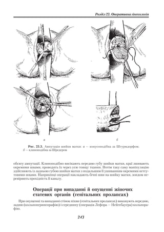 Розділ 23. Оперативна гінекологія




                  а                                            б

         Рис. 23.3. Ампутація шийки матки: а — конусоподібна за Штурмдорфом;
      б — клиноподібна за Шредером



обсягу ампутації. Клиноподібно висікають передню губу шийки матки, краї зшивають
окремими швами, проводять їх через усю товщу тканин. Потім таку саму маніпуляцію
здійснюють із задньою губою шийки матки з подальшим її ушиванням окремими кетгу
товими швами. Наприкінці операції накладають бічні шви на шийку матки, зондом пе
ревіряють прохідність її каналу.


            Операції при випаданні й опущенні жіночих
            статевих органів (генітальних пролапсах)
   При опущенні та випаданні стінок піхви (генітальних пролапсах) виконують передню,
задню (кольпоперинеорафію) і серединну (операція Лефора — Нейгебауера) кольпора
фію.

                                       243
 