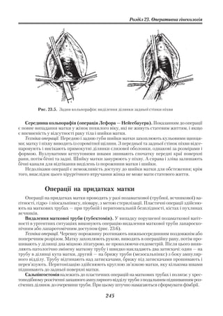 Розділ 23. Оперативна гінекологія




         Рис. 23.5. Задня кольпорафія: виділення ділянки задньої стінки піхви


   Серединна кольпорафія (операція Лефора — Нейгебауера). Показанням до операції
є повне випадання матки у жінок похилого віку, які не живуть статевим життям, і якщо
є впевненість у відсутності раку тіла і шийки матки.
   Техніка операції. Передню і задню губи шийки матки захоплюють кульовими щипця
ми; матку і піхву виводять із соромітної щілини. З передньої та задньої стінок піхви відсе
паровують і висікають прямокутні ділянки слизової оболонки, однакові за розмірами і
формою. Вузлуватими кетгутовими швами зшивають спочатку передні краї поверхні
рани, потім бічні та задні. Шийку матки занурюють у піхву. А справа і зліва залишають
бічні канали для відтікання виділень із порожнини матки і шийки.
   Недоліками операції є неможливість доступу до шийки матки для обстеження; крім
того, внаслідок цього хірургічного втручання жінка не може мати статевого життя.


            Операції на придатках матки
    Операції на придатках матки проводять у разі позаматкової (трубної, яєчникової) ва
гітності, гідро і піосальпінксу, піовару, з метою стерилізації. Пластичні операції здійсню
ють на маткових трубах — при трубній і перитонеальній безплідності, кістах і пухлинах
яєчників.
    Видалення маткової труби (тубектомія). У випадку порушеної позаматкової вагіт
ності в ургентних ситуаціях виконують операцію видалення маткової труби лапароско
пічним або лапаротомічним доступом (рис. 23.6).
    Техніка операції. Черевну порожнину розтинають нижньосерединним поздовжнім або
поперечним розрізом. Матку захоплюють рукою, виводять в операційну рану, потім про
шивають у ділянці дна міцною лігатурою, не проколюючи ендометрій. Після цього вияв
ляють патологічно змінену маткову трубу і швидко накладають два затискачі: один — на
трубу в ділянці кута матки, другий — на брижу труби (мезосальпінкс) з боку ампуляр
ного відділу. Трубу відтинають над затискачами, брижу під затискачами прошивають і
перев’язують. Перитонізацію здійснюють круглою зв’язкою матки, яку кількома швами
підшивають до задньої поверхні матки.
    Сальпінгостомія належить до пластичних операцій на маткових трубах і полягає у хрес
топодібному розсіченні запаяного ампулярного відділу труби з подальшим підшиванням роз
січених ділянок до очеревини труби. При цьому штучно намагаються сформувати фімбрії.

                                           245
 