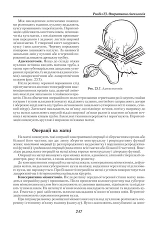 Розділ 23. Оперативна гінекологія

    Між накладеними затискачами ножиця
ми розтинають тканини, пухлину видаляють,
куксу прошивають і перев’язують. Перитоні
зацію здійснюють кисетним швом, починаю
чи від кута матки, з послідовним прошиван
ням переднього і заднього листків широкої
зв’язки матки. У створений кисет занурюють
куксу і шов затягують. Черевну порожнину
пошарово зашивають наглухо. За наявності
запальних змін у пухлині або в черевній по
рожнині залишають дренажну трубку.
    Аднексектомія. Якщо до складу ніжки
пухлини яєчника входить маткова труба, а
також при тубооваріальних запальних утво
реннях придатків, їх видаляють (аднексекто
мія) лапароскопічним або лапаротомічним
шляхом (рис. 23.7).
    Після розтину черевної порожнини слід
орієнтуватися в анатомо топографічних взає      Рис. 23.7. Аднексектомія
мовідношеннях органів таза, зазвичай зміне
них внаслідок запального і спайкового про
цесів. Після обмеження операційного поля стерильними серветками роз’єднують спайки
гострим і тупим шляхами (спочатку відділяють сальник, потім його заправляють догори
і обережно відділяють від трубно яєчникового запального утворення петлі кишок, сечо
вий міхур). Затискачі накладають на зв’язку, що підвішує яєчник, потім у напрямку до
кута матки захоплюють верхній відділ широкої зв’язки разом із власною зв’язкою яєч
ника і матковим кінцем труби. Захоплені тканини перерізають і перев’язують. Перитоні
зацію виконують круглою і широкою зв’язками матки.


            Операції на матці
    На матці виконують такі операції: консервативні операції зі збереженням органа або
більшої його частини, що дає змогу зберегти менструальну і репродуктивну функції
жінки; пластичні операції (у разі природжених вад розвитку і порушення репродуктив
ної функції) і радикальні операції (видалення всієї матки або більшої її частини). Внас
лідок радикальних операцій на матці жінка втрачає менструальну і дітородну функції.
    Операції на матці виконують при міомах матки, аденоміозі, атиповій гіперплазії ен
дометрія, раку тіла матки, а також аномаліях розвитку.
    До консервативних операцій на матці належать: консервативна міомектомія, дефун
дація матки, видалення субсерозного вузла на ніжці, видалення через піхву підслизово
го вузла, що народжується. При більшості операцій на матці з успіхом використовується
лапароскопічна і гістероскопічна вагінальна хірургія.
    Консервативна міомектомія. Після розтину передньої черевної стінки матку виво
дять в операційну рану і прошивають. Після проведення колового розтину над субсероз
ним міоматозним вузлом його захоплюють кульовими щипцями, піднімають та відділя
ють тупим шляхом. На натягнуті м’язові волокна накладають затискачі та видаляють ву
зол. Гемостаз у рані здійснюють шляхом накладання м’язово м’язових швів. Перитоні
зацію виконують серозним покривом вузла.
    При інтрамуральному розміщенні міоматозного вузла над пухлиною розтинають оче
ревину і стоншену м’язову тканину (капсулу). Вузол захоплюють двозубцями і за допо

                                         247
 