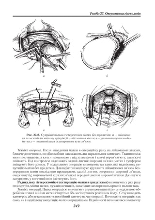 Розділ 23. Оперативна гінекологія




                     а                                             б




                     в                                             г
          Рис. 23.8. Суправагінальна гістеректомія матки без придатків: а — накладан
      ня затискачів на маткову артерію; б — відтинання матки; в — ушивання кукси шийки
      матки; г — перитонізація із зануренням кукс зв’язок


   Техніка операції. Після виведення матки в операційну рану на лійкотазові зв’язки,
ближче до яєчників, по обидва боки накладають два паралельних затискачі. Тканини між
ними розтинають, а кукси прошивають під затискачем і тричі перев’язують, затискачі
знімають. Під контролем надсікають задній листок широкої зв’язки матки і тупфером
зміщують його донизу. У подальшому операцію виконують так само, як і надпіхвову ам
путацію матки без придатків. Для перитонізації кукс круглої та лійкотазової зв’язок без
перервним швом послідовно прошивають задній листок очеревини широкої зв’язки,
очеревину lig. suspensorium і круглої зв’язки і передній листок широкої зв’язки. Далі кукси
занурюють у кисетний шов і затягують його.
   Радикальну гістеректомію (екстирпацію матки з придатками) виконують у разі раку
ендометрія, міоми матки, пухлин яєчників, запальних захворювань органів малого таза.
   Техніка операції. Перед операцією виконують спринцювання піхви з подальшою об
робкою піхви і шийки матки спиртом і 5% м спиртовим розчином йоду. Сечу виводять
катетером або встановлюють постійний катетер на час операції. Починають операцію так
само, як і надпіхвову ампутацію матки з придатками. Відмінності починаються з моменту
                                           249
 