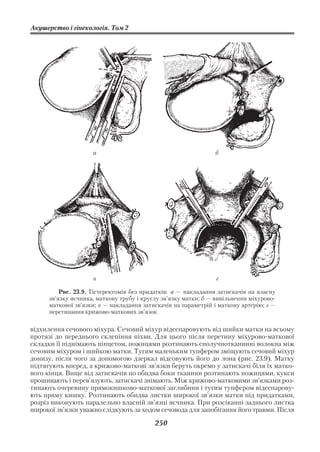 Акушерство і гінекологія. Том 2




                     а                                          б




                     в                                           г

          Рис. 23.9. Гістеректомія без придатків: а — накладання затискачів на власну
      зв’язку яєчника, маткову трубу і круглу зв’язку матки; б — вивільнення міхурово
      маткової зв’язки; в — накладання затискачів на параметрій і маткову артерію; г —
      перетинання крижово маткових зв’язок

відхилення сечового міхура. Сечовий міхур відсепаровують від шийки матки на всьому
протязі до переднього склепіння піхви. Для цього після перетину міхурово маткової
складки її піднімають пінцетом, ножицями розтинають сполучнотканинні волокна між
сечовим міхуром і шийкою матки. Тугим маленьким тупфером зміщують сечовий міхур
донизу, після чого за допомогою дзеркал відсовують його до лона (рис. 23.9). Матку
підтягують вперед, а крижово маткові зв’язки беруть окремо у затискачі біля їх матко
вого кінця. Вище від затискачів по обидва боки тканини розтинають ножицями, кукси
прошивають і перев’язують, затискачі знімають. Між крижово матковими зв’язками роз
тинають очеревину прямокишково маткової заглибини і тугим тупфером відсепарову
ють пряму кишку. Розтинають обидва листки широкої зв’язки матки під придатками,
розріз виконують паралельно власній зв’язці яєчника. При розсіканні заднього листка
широкої зв’язки уважно слідкують за ходом сечовода для запобігання його травми. Після

                                           250
 