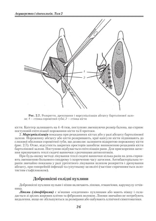 Акушерство і гінекологія. Том 2




                                                 1

                                                 2




          Рис. 2.7. Розкриття, дренування і марсупіалізація абсцесу бартолінової зало
      зи: 1 — стінка соромітної губи; 2 — стінка кісти

кісти. Катетер залишають на 4–6 тиж, поступово зменшуючи розмір балона, що сприяє
поступовій епітелізації порожнини кісти та її протоки.
   2. Марсупіалізація показана при рецидивних кістах або у разі абсцесу бартолінової
залози. Порожнину абсцесу або кісти розкривають, краї капсули кісти підшивають до
слизової оболонки соромітної губи, що дозволяє залишити відкритою порожнину кісти
(рис. 2.7). Отже, відсутність закритих просторів запобігає виникненню рецидивів кісти
бартолінової залози. Поступово відбувається епітелізація рани. Для прискорення загоє
ння призначають теплі сидячі ванночки з розчинами антисептиків.
   При будь якому методі лікування теплі сидячі ванночки кілька разів на день сприя
ють зменшенню больового синдрому і скороченню часу загоєння. Антибактеріальна те
рапія звичайно показана у разі ургентного лікування шляхом розкриття і дренування
абсцесу, при гонорейній інфекції та супутньому целюліті (частіше спричинюється золо
тистим стафілококом).

            Доброякісні солідні пухлини
   Доброякісні пухлини вульви і піхви включають ліпоми, гемангіоми, карункулу сечів
ника.
   Ліпоми (ліпофіброми) є м’якими «сидячими» пухлинами або мають ніжку і скла
дається зі зрілих жирових клітин та фіброзних волокон. Ліпоми звичайно не потребують
видалення, якщо не збільшуються за розмірами або набувають клінічної симптоматики.

                                            26
 