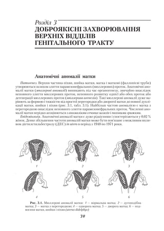 Акушерство і гінекологія. Том 2

            Розділ 3
            ДОБРОЯКІСНІ ЗАХВОРЮВАННЯ
            ВЕРХНІХ ВІДДІЛІВ
            ГЕНІТАЛЬНОГО ТРАКТУ




            Анатомічні аномалії матки
   Патогенез. Верхня частина піхви, шийка матки, матка і маткові (фаллопієві труби)
утворюються шляхом злиття парамезонефральних (мюллерових) проток. Анатомічні ано
малії матки (мюллерові аномалії) виникають під час органогенезу, звичайно внаслідок
неповного злиття мюллерових проток, неповного розвитку однієї або обох проток або
дегенерації мюллерових проток (мюллерова агенезія). Такі мюллерові аномалії дуже ва
ріюють за формою і тяжкістю від простої перегородки або дворогої матки до повної дуплі
кації матки, шийки і піхви (рис. 3.1, табл. 3.1). Найбільш частою аномалією є матка з
перегородкою внаслідок неповного злиття парамезонефральних проток. Численні ано
малії матки нерідко асоціюються з аномаліями сечових шляхів і паховими грижами.
   Епідеміологія. Анатомічні аномалії матки є дуже рідкісними і спостерігаються у 0,02 %
жінок. Деяке збільшення частоти аномалій матки може бути пов’язане з можливим впли
вом діетилстильбестролу (ДЕС) in utero в період з 1940 по 1971 роки.




             1                              2                               3




             4                              5                               6
         Рис. 3.1. Мюллерові аномалії матки: 1 — нормальна матка; 2 — дугоподібна
      матка; 3 — матка з перегородкою; 4 — однорога матка; 5 — дворога матка; 6 — под
      воєння матки, шийки і піхви (uterus didelphys)

                                           30
 
