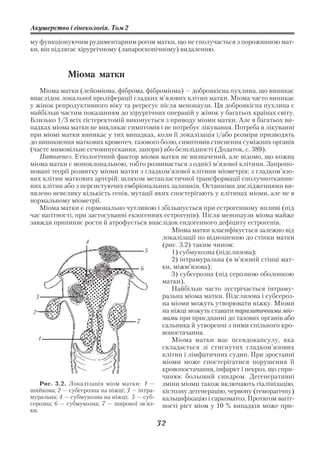 Акушерство і гінекологія. Том 2

му функціонуючим рудиментарним рогом матки, що не сполучається з порожниною мат
ки, він підлягає хірургічному (лапароскопічному) видаленню.


            Міома матки
    Міома матки (лейоміома, фіброма, фіброміома) — доброякісна пухлина, що виникає
внаслідок локальної проліферації гладких м’язових клітин матки. Міома часто виникає
у жінок репродуктивного віку та регресує після менопаузи. Ця доброякісна пухлина є
найбільш частим показанням до хірургічних операцій у жінок у багатьох країнах світу.
Близько 1/3 всіх гістеректомій виконується з приводу міоми матки. Але в багатьох ви
падках міома матки не викликає симптомів і не потребує лікування. Потреба в лікуванні
при міомі матки виникає у тих випадках, коли її локалізація і/або розміри призводять
до виникнення маткових кровотеч, тазового болю, симптомів стиснення суміжних органів
(часте мимовільне сечовипускання, запори) або безплідності (Додаток, с. 389).
    Патогенез. Етіологічний фактор міоми матки не визначений, але відомо, що кожна
міома матки є моноклональною, тобто розвивається з однієї м’язової клітини. Запропо
новані теорії розвитку міоми матки з гладком’язової клітини міометрія; з гладком’язо
вих клітин маткових артерій; шляхом метапластичної трансформації сполучнотканин
них клітин або з персистуючих ембріональних залишків. Останніми дослідженнями ви
явлено невелику кількість генів, мутації яких спостерігають у клітинах міоми, але не в
нормальному міометрії.
    Міома матки є гормонально чутливою і збільшується при естрогенному впливі (під
час вагітності, при застосуванні екзогенних естрогенів). Після менопаузи міома майже
завжди припиняє рости й атрофується внаслідок ендогенного дефіциту естрогенів.
                                               Міома матки класифікується залежно від
                                            локалізації по відношенню до стінки матки
                   4
                                            (рис. 3.2) таким чином:
                                         5     1) субмукозна (підслизова);
                                               2) інтрамуральна (в м’язовій стінці мат
                                       6    ки, міжм’язова);
                                               3) субсерозна (під серозною оболонкою
                                            матки).
                                               Найбільш часто зустрічається інтраму
  3                                         ральна міома матки. Підслизова і субсероз
                                            на міоми можуть утворювати ніжку. Міоми
 2                                          на ніжці можуть ставати паразитичними міо
                                     7
                                            мами при приєднанні до тазових органів або
                                            сальника й утворенні з ними спільного кро
                                            вопостачання.
   1                                           Міома матки має псевдокапсулу, яка
                                            складається зі стиснутих гладком’язових
                                            клітин і лімфатичних судин. При зростанні
                                            міоми може спостерігатися порушення її
                                            кровопостачання, інфаркт і некроз, що спри
                                            чинює больовий синдром. Дегенеративні
    Рис. 3.2. Локалізація міом матки: 1 — зміни міоми також включають гіалінізацію,
шийкова; 2 — субсерозна на ніжці; 3 — інтра кістозну дегенерацію, червону (геморагічну)
муральна; 4 — субмукозна на ніжці; 5 — суб  кальцифікацію і саркоматоз. Протягом вагіт
серозна; 6 — субмукозна; 7 — широкої зв’яз  ності ріст міом у 10 % випадків може при
ки.

                                         32
 