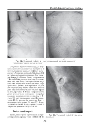 Розділ 5. Інфекції нижнього відділу...




                      а                                         б
         Рис. 5.2. Вторинний сифіліс: а — папулосквамозний висип на долонях; б —
      типові мідно червоні папули на спині

    Лікування. Препаратом вибору для ліку
вання сифілісу залишається пеніцилін. З
метою лікування раннього сифілісу засто
совують бензатин пеніцилін G 2,4 млн ОД
внутрішньом’язово одноразово. При трива
лості сифілісу більше 1 року призначають
2,4 млн ОД бензатин пеніциліну G щотиж
нево протягом 3 тиж. Альтернативним ліку
ванням є внутрішньовенне введення цеф
тріаксону 4 рази на день протягом 10 днів
або тетрацикліну 500 мг орально 4 рази на
день чи доксицикліну 100 мг орально 2 рази
на день протягом 2–4 тиж. Нейросифіліс є
дуже небезпечною інфекцією і потребує
введення кристаличного пеніциліну G 2–
4 млн ОД внутрішньовенно кожні 4 год про
тягом 10–14 днів, потім вводяться 3 внут
рішньом’язові дози (по 2,4 млн ОД) бенза
тин пеніциліну G. Контроль ефективності
лікування проводять через 3–6 міс.

      Генітальний герпес
   Генітальний герпес спричинюється віру        Рис. 5.3. Третинний сифіліс (гума, що за
сом простого герпесу типів І і ІІ (ВПГ 1 і   гоюється)

                                         53
 