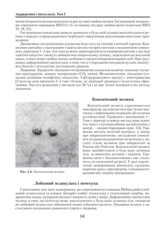 Акушерство і гінекологія. Том 2

матки (інтраепітеліальна неоплазія та рак вульви і шийки матки). Гострокінцеві кондило
ми спричинені переважно ВПЛ 6 і 11, на відміну від раку шийки матки (серотипи ВПЛ
16, 18, 31).
   Гострокінцеві кондиломи можуть виникати в будь якій ділянці аногенітального ре
гіону і нерідко супроводжуються свербежем і кров’яними виділеннями внаслідок трав
мування.
   Діагностика гострокінцевих кондилом базується на типовій клінічній картині. Кон
диломи звичайно є маленькими і мають вигляд гострих сосочків з оксамитовою поверх
нею, діаметром 1–5 мм. Але інколи вони характеризуються надмірним ростом у вигляді
«цвітної капусти» і можуть займати всю аноректальну ділянку, переходити на анальний
канал, стінки піхви і шийку матки, особливо в імуноскомпроментованих осіб. При труд
нощах диференційної діагностики, в тому числі з бородавчастим раком вульви, викону
ють біопсію і гістологічне дослідження уражень.
   Лікування. Хірургічне лікування гострокінцевих кондилом включає локальну ексци
зію, кріохірургію, лазерну вапоризацію (СО2 лазер). Медикаментозне лікування (ло
кальна аплікація подофіліну, кондиліну, 5 фторурацилового крему) є довготривалим
(2 рази на день протягом 3–4 тиж і більше, до ліквідації уражень) і недостатньо ефек
тивним. Частота рецидивів є високою (до 20 %) і не має чіткої залежності від методу
лікування.


                                                 Контагіозний молюск
                                             Контагіозний молюск спричинюється
                                          поксвірусом, що передається при тісних кон
                                          тактах з інфікованим індивідом або шляхом
                                          аутоінокуляції. Ураження є маленькими, 1–
                                          5 мм у діаметрі та мають вигляд дещо підня
                                          тих папул з пупкоподібним заглибленням у
                                          центрі — «водяні бородавки» (рис. 5.6). Ура
                                          ження містять вологий матеріал, в якому
                                          при мікроскопічному дослідженні виявля
                                          ють інтрацитоплазматичні включення у ви
                                          гляді тілець молюска при забарвленні за
                                          Гімзою або Райтсом. Контагіозний молюск
                                          може маніфестувати в будь яких ділянках
                                          тіла, за винятком долоней і підошов. Ура
                                          ження часто є безсимптомним і має схиль
                                          ність до спонтанної регресії. У разі персис
                                          тенції захворювання виконують ексцизію,
                                          кюретаж папул, кріохірургію, електрокауте
   Рис. 5.6. Контагіозний молюск          ризацію або лазерну вапоризацію.


            Лобковий педикульоз і почесуха
   Симптомами цих двох захворювань, що спричинюються вошами Phthirus pubis (лоб
ковий педикульоз) та кліщем Sarcoptes scabiei (почесуха), є інтенсивний свербіж, по
дразнення шкіри, пухирцеві висипи і наявність ходів у шкірі. Диференційна діагностика
полягає в тому, що почесуха може локалізуватись у будь яких ділянках тіла, тимчасом
як лобковий педикульоз обмежений зоною лобкового волосся. Лікування полягає у за
стосуванні спеціальних шампунів і спреїв з лінданом.

                                         56
 