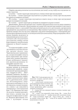 Розділ 7. Опущення тазових органів...

    Ступінь пролапсу визначається величиною дистанції, на яку відбулося опущення та
зових структур:
    І ступінь — тазові структури знаходяться у межах піхви при натужуванні.
    ІІ ступінь — тазові структури опускаються до рівня входу в піхву при натужуванні
(до рівня вульварного кільця).
    ІІІ ступінь — тазові структури опускаються нижче входу в піхву при натужуванні
(нижче вульварного кільця).
    IV ступінь — тазові структури за межами вульварного кільця в спокої.
    Діагностика. Діагноз релаксації таза і тазових пролапсів базується на даних анамнезу
і об’єктивного обстеження. Додатковими методами обстеження при наявності цистоцелє
і уретроцистоцелє є загальний і бактеріологічний аналіз сечі, цистоскопія, уретроскопія
уродинамічне дослідження за показаннями. При наявності ректоцелє і скаргах хворих на
хронічні запори, біль під час акту дефекації, утруднене випорожнення, є показаними ано
скопія (ректороманоскопія) та сигмоїдоскопія (колоноскопія). Передопераційне обсте
ження повинно включати за
показаннями результати цито
логічного або гістологічного
дослідження шийки матки
(при наявності декубітальних
виразок) та біопсії ендомет
рія.                                     3 см
    Ультрасонографія дозво
ляє виявити супутню патоло
гію органів малого таза.
Трансвагінальна і промежин
на ультрасонографія можуть
бути корисними при визна
ченні типу тазового пролапсу.
В разі необхідності викону
ють магнітно резонансну то
мографію органів таза.
    Кількісний опис положення
тазових органів за системою
вагінального профілю, запро
понований групою міжнарод
них товариств (ICS — Inter                                       а
national Continence Society), а
також міжнародними товари
                                     Рис. 7.5. Схема розрахунку по
ствами гінекологічних хірур
                                  ложення тазових органів (вагі
гів та урогінекологів, дозво      нального профілю):
ляє об’єктивізувати і доку           а — локалізація контрольних
ментувати особливості та ста      точок (використовують 6 точок: Аа,
дії порушень тазової підтрим      Ва, С, D, Вр, Ар, вхід у піхву (gh),
ки у жінок і дає можливість тільце промежини (pb) і загальну                    б
динамічного спостереження довжину піхви (tvl);
(рис. 7.5). Принцип цієї шка         б — схема 3х3 для швидкої оцінки ступеня тазових про
ли полягає в оцінці анатоміч      лапсів (POP Q);
них точок у ділянці таза, які        Аа — точка А на передній стінці піхви; Ва — точка В на
                                  передній стінці піхви; С — шийка матки або склепіння піхви;
поділені на фіксовані та змін     D — заднє склепіння піхви; gh — вхід у піхву; Ap — точка А
ні. Першою фіксованою точ         на задній стінці піхви; Bp — точка В на задній стінці піхви
кою є вульварне кільце (пояснення в тексті)

                                            75
 