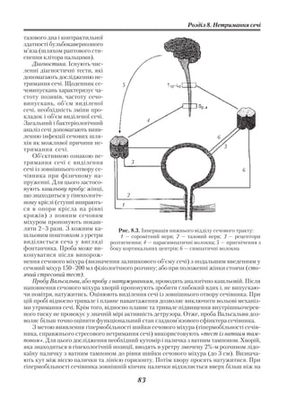 Розділ 8. Нетримання сечі

тазового дна і контрактильної
здатності бульбокавернозного
м’яза (шляхом раптового сти
снення клітора пальцями).
   Діагностика. Існують чис
ленні діагностичні тести, які
допомагають дослідженню не
тримання сечі. Щоденник се           5
човипускань характеризує ча
стоту позивів, частоту сечо
випускань, об’єм виділеної
сечі, необхідність зміни про
кладок і об’єм виділеної сечі.
                                               4
Загальний і бактеріологічний
аналіз сечі допомагають вияв
ленню інфекції сечових шля                                                 6
хів як можливої причини не
                                                                             3
тримання сечі.
   Об’єктивною ознакою не
тримання сечі є виділення                3
сечі із зовнішнього отвору се                                                       6
чівника при фізичному на
пруженні. Для цього застосо
вують кашльову пробу: жінці,
що знаходиться у гінекологіч           2
ному кріслі (ступні впирають         1
ся в опори крісла на рівні
крижів) з повним сечовим
міхуром пропонують покаш
ляти 2–3 рази. З кожним ка         Рис. 8.3. Іннервація нижнього відділу сечового тракту:
шльовим поштовхом з уретри          1 — соромітний нерв; 2 — тазовий нерв; 3 — рецептори
виділяється сеча у вигляді розтягнення; 4 — парасимпатичні волокна; 5 — пригнічення з
фонтанчика. Проба може ви       боку кортикальних центрів; 6 — симпатичні волокна
конуватися після випорож
нення сечового міхура (визначення залишкового об’єму сечі) з подальшим введенням у
сечовий міхур 150–200 мл фізіологічного розчину; або при положенні жінки стоячи (сто
ячий стресовий тест).
   Пробу Вальсальви, або пробу з натужуванням, проводять аналогічно кашльовій. Після
наповнення сечового міхура хворій пропонують зробити глибокий вдих і, не випускаю
чи повітря, натужитись. Оцінюють виділення сечі із зовнішнього отвору сечівника. При
цій пробі відносно тривале і плавне навантаження дозволяє виключити вольові механіз
ми утримання сечі. Крім того, відносно плавне та тривале підвищення внутрішньочерев
ного тиску не провокує у значній мірі активність детрузора. Отже, проба Вальсальви доз
воляє більш точно оцінити функціональний стан гладком’язового сфінктера сечівника.
   З метою виявлення гіпермобільності шийки сечового міхура (гіпермобільності сечів
ника, справжнього стресового нетримання сечі) використовують «тест із ватним там
поном». Для цього дослідження необхідний кутомір і паличка з ватним тампоном. Хворій,
яка знаходиться в гінекологічній позиції, вводять в уретру змочену 2% м розчином лідо
каїну паличку з ватним тампоном до рівня шийки сечового міхура (до 3 см). Визнача
ють кут між віссю палички та лінією горизонту. Потім хвору просять натужитися. При
гіпермобільності сечівника зовнішній кінчик палички відхиляється вверх більш ніж на

                                          83
 