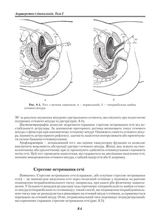 Акушерство і гінекологія. Том 2




                   а                                              б
         Рис. 8.4. Тест з ватним тампоном: а — нормальний; б — гіпермобільна шийка
      сечового міхура


30° за рахунок опущення міхурово уретрального сегмента, що свідчить про недостатню
підтримку сечового міхура та уретри (рис. 8.4).
    Цистометрографія дозволяє відрізнити справжнє стресове нетримання сечі від не
стабільності детрузора. За допомогою пресорного датчика визначають тонус сечового
міхура і сфінктера при наповненому сечовому міхурі. Оцінюють ємність сечового міху
ра, наявність детрузорного рефлексу, здатність пацієнтки контролювати або пригнічува
ти сильне бажання сечовипускання.
    Урофлоуметрія — неінвазивний тест, що оцінює евакуаторну функцію та дозволяє
виключити можливість обструкції уретри і сечового міхура. Жінці, яка лежить на гіне
кологічному або урологічному кріслі, пропонують здійснити сечовипускання і оцінюють
потік сечі. Цей тест проводять пацієнткам, які скаржаться на зволікання виділення сечі,
неповне випорожнення сечового міхура, слабкий напір сечі або її затримку.


            Стресове нетримання сечі
   Патогенез. Стресове нетримання сечі (справжнє, або генуїнне стресове нетримання
сечі) — це мимовільне виділення сечі через інтактний сечівник у відповідь на раптове
підвищення інтраабдомінального тиску, наприклад, при кашлі або фізичному наванта
женні. У більшості випадків релаксація таза спричинює гіпермобільність шийки сечово
го міхура (гіпермобільність сечівника) у такий спосіб, що підвищення інтраабдоміналь
ного тиску вже не розподіляється рівномірно на сечовий міхур і сечівник, а спрямовується
переважно на сечовий міхур. Отже, інтравезикальний тиск перевищує інтрауретральний,
що спричинює справжнє стресове нетримання сечі (рис. 8.5).

                                          84
 