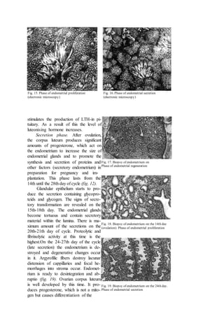 stimulates the production of LTH-in pi-
tuitary. As a result of this the level of
luteonising hormone increases.
Secretion phase. After ovulation,
the corpus luteum produces significant
amounts of progesterone, which act on
the endometrium to increase the size of
endometrial glands and to promote the
synthesis and secretion of proteins and
other factors (secretory endometrium) in
preparation for pregnancy and im-
plantation. This phase lasts from the
14th until the 28th day of cycle (fig. 12).
Glandular epithelium starts to pro-
duce the secretion containing glycopro-
teids and glycogen. The signs of secre-
tory transformation are revealed on the
15th-18th day. The endometrial glands
become tortuous and contain secretory
material within the lumina. There is ma-
ximum amount of the secretions on the
20th-21th day of cycle. Proteolytic and
fibrinolytic activity at this time is the
highest.On the 24-27th day of the cycle
(late secretion) the endometrium is de-
stroyed and degenerative changes occur
in it. Argyrofilic fibers destroy lacunar
distension of cappillaries and focal he-
morrhages into stroma occur. Endomet-
rium is ready to desintegration and ab-
ruptio (fig. 19). Ovarian corpus luteum
is well developed by this time. It pro-
duces progesterone, which is not a mito-
gen but causes differentiation of the
Fig. 15. Phase of endometrial proliferation Fig. 16. Phase of endometrial secretion
(electronic microscopy) (electronic microscopy)
Fig. 17. Biopsy of endometrium on
Phase of endometrial regeneration
Fig. 18. Biopsy of endometrium on the 14th day
(ovulation). Phase of endometrial proliferation
Fig. 19. Biopsy of endometrium on the 24th day.
Phase of endometrial secretion
 