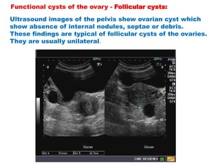 Gynecology Ultrasound PDF 11 (1). female pelvic ultrasound pdf | PDF