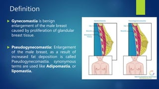 pseudogynecomastia-test