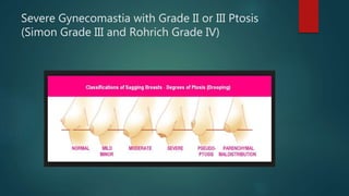 Severe Gynecomastia with Grade II or III Ptosis
(Simon Grade III and Rohrich Grade IV)
 