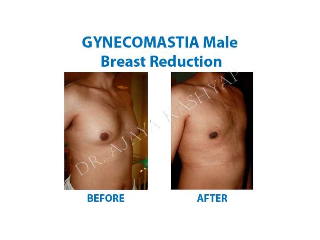 Male Breast Reduction Surgery in Delhi, INDIA