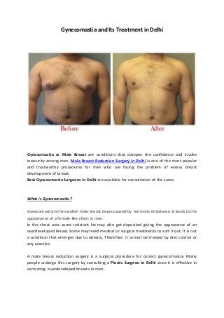 Gynecomastia and Its Treatment in Delhi
Gynecomastia or Male Breast are conditions that dampen the confidence and invoke
insecurity among men. Male Breast Reduction Surgery in Delhi is one of the most popular
and trustworthy procedures for men who are facing the problem of excess breast
development of breast.
Best Gynecomastia Surgeons in Delhi are available for consultation of the same.
What is Gynecomastia ?
Gynecomastia is the swollen male breast tissue caused by hormone imbalance. It leads to the
appearance of a female-like chest in men.
In the chest area some resistant fat may also get deposited giving the appearance of an
overdeveloped breast. Some may need medical or surgical treatments to sort it out. It is not
a condition that emerges due to obesity. Therefore it cannot be treated by diet control or
any exercise.
A male breast reduction surgery is a surgical procedure for correct gynecomastia. Many
people undergo this surgery by consulting a Plastic Surgeon in Delhi since it is effective in
correcting overdeveloped breasts in men.
 