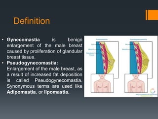 Definition
• Gynecomastia is benign
enlargement of the male breast
caused by proliferation of glandular
breast tissue.
• Pseudogynecomastia:
Enlargement of the male breast, as
a result of increased fat deposition
is called Pseudogynecomastia.
Synonymous terms are used like
Adipomastia, or lipomastia.
 