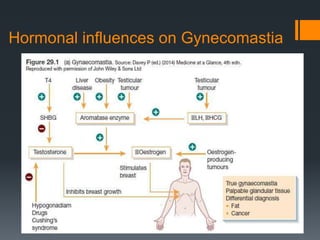 Hormonal influences on Gynecomastia
 
