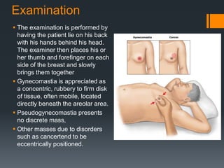 Examination
 The examination is performed by
having the patient lie on his back
with his hands behind his head.
The examiner then places his or
her thumb and forefinger on each
side of the breast and slowly
brings them together
 Gynecomastia is appreciated as
a concentric, rubbery to firm disk
of tissue, often mobile, located
directly beneath the areolar area.
 Pseudogynecomastia presents
no discrete mass,
 Other masses due to disorders
such as cancertend to be
eccentrically positioned.
 