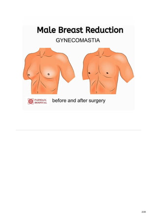 Gynecomastia surgery cost in hyderabad