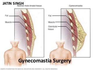 Gynecomastia Surgery
JATIN SINGH
 