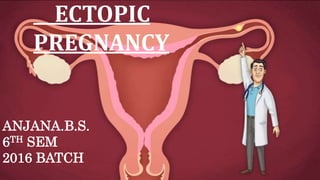 ECTOPIC
PREGNANCY
ANJANA.B.S.
6TH SEM
2016 BATCH
 