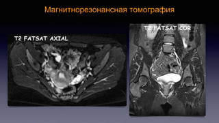 Imaging of deep pelvic infiltarting endometriosis | PPTX