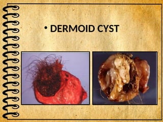 • DERMOID CYST
 