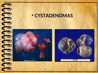 • CYSTADENOMAS
 