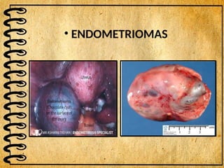 • ENDOMETRIOMAS
 