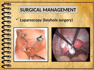 SURGICAL MANAGEMENT
 Laparoscopy (keyhole surgery)
 