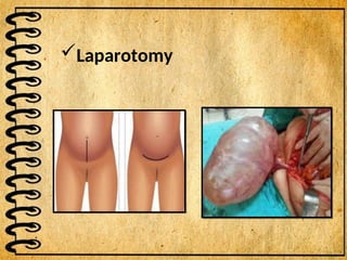 Laparotomy
 