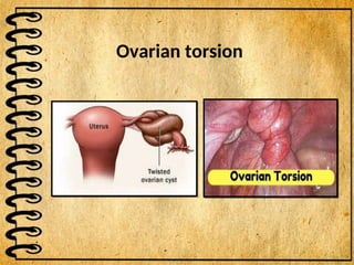 Ovarian torsion
 