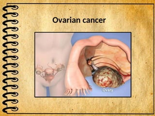 Ovarian cancer
 