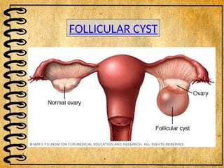 v
FOLLICULAR CYST
 