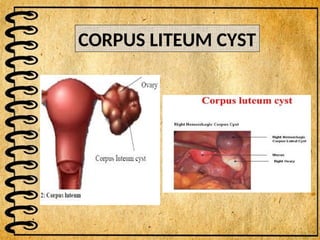CORPUS LITEUM CYST
 