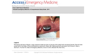 Date of download: 1/19/2014 Copyright © 2012 McGraw-Hill Medical. All rights reserved.
Necrotizing soft tissue infection. Large cutaneous bullae are seen on the leg of this patient with necrotizing fasciitis. Note the dark
purple fluid in the bullae. (Photo contributed by Lawrence B. Stack, MD. Reproduced with permission from Knoop K, Stack L,
Storrow A, Thurman RJ: Atlas of Emergency Medicine, 3rd ed. © 2010, McGraw-Hill, New York.)
Legend:
From: Soft Tissue Infections
Tintinalli's Emergency Medicine: A Comprehensive Study Guide, 2011
 