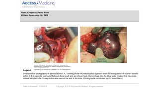 Date of download: 1/16/2014 Copyright © 2012 McGraw-Hill Medical. All rights reserved.
Intraoperative photographs of adnexal torsion. A. Twisting of the infundibulopelvic ligament leads to strangulation of ovarian vessels
within it. B. A cyanotic ovary and fallopian tube result and are shown here. Hemorrhage into the tubal walls created this massively
dilated fallopian tube. Dusky fimbria are seen at the end of the tube. (Photographs contributed by Dr. Jason Harn.)
Legend:
From: Chapter 9. Pelvic Mass
Williams Gynecology, 2e, 2012
 