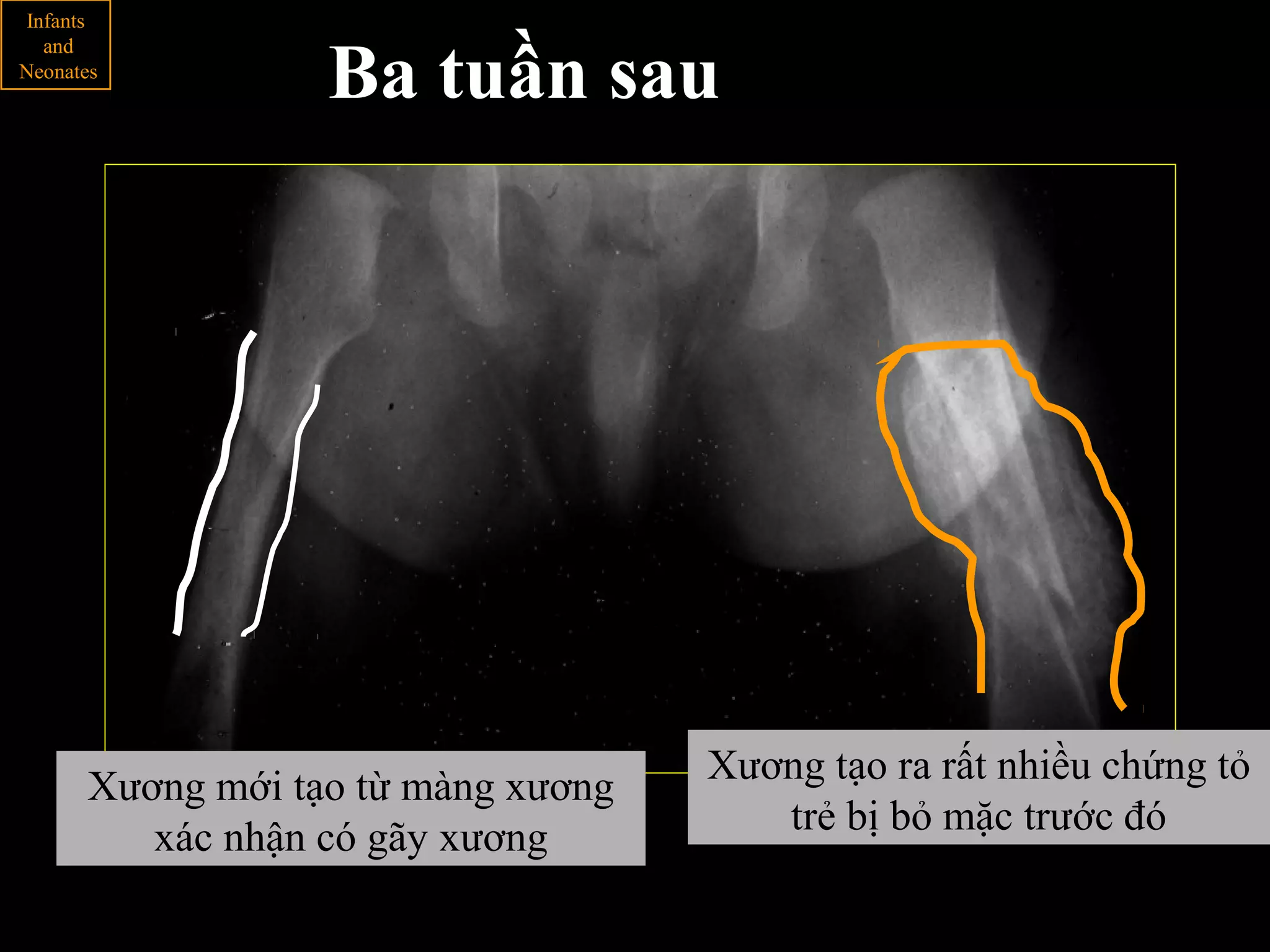 Xương tạo ra rất nhiều chứng tỏ
trẻ bị bỏ mặc trước đó
Xương mới tạo từ màng xương
xác nhận có gãy xương
Infants
and
Neonates
Ba tuần sau
 