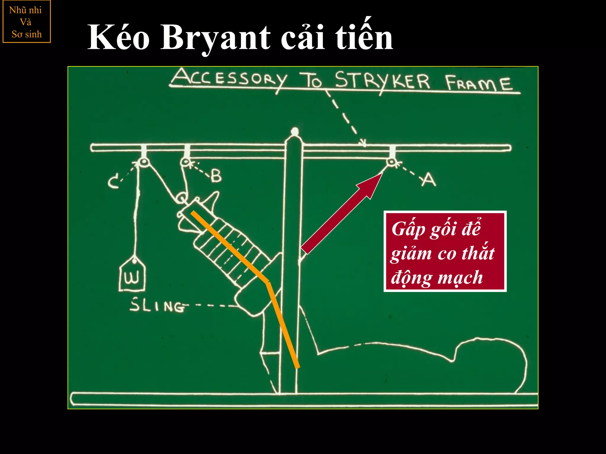 Kéo Bryant cải tiến
Gấp gối để
giảm co thắt
động mạch
Nhũ nhi
Và
Sơ sinh
 