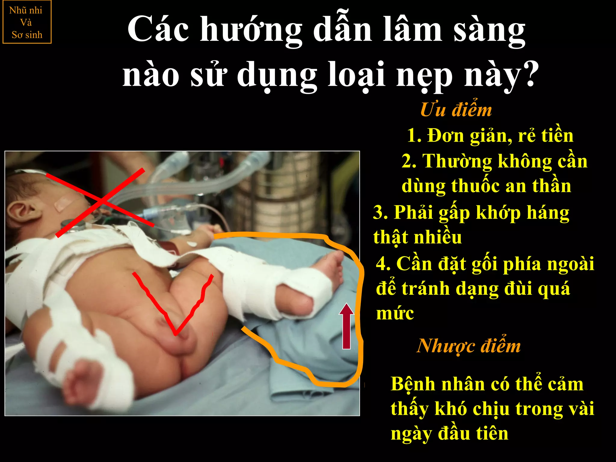 Các hướng dẫn lâm sàng
nào sử dụng loại nẹp này?
1. Đơn giản, rẻ tiền
2. Thường không cần
dùng thuốc an thần
4. Cần đặt gối phía ngoài
để tránh dạng đùi quá
mức
Bệnh nhân có thể cảm
thấy khó chịu trong vài
ngày đầu tiên
Nhũ nhi
Và
Sơ sinh
Nhược điểm
Ưu điểm
3. Phải gấp khớp háng
thật nhiều
 